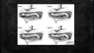 Carotid cavernous fistula | PPTX