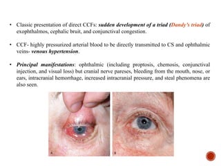 • Classic presentation of direct CCFs: sudden development of a triad (Dandy’s triad) of
exophthalmos, cephalic bruit, and conjunctival congestion.
• CCF- highly pressurized arterial blood to be directly transmitted to CS and ophthalmic
veins- venous hypertension.
• Principal manifestations: ophthalmic (including proptosis, chemosis, conjunctival
injection, and visual loss) but cranial nerve pareses, bleeding from the mouth, nose, or
ears, intracranial hemorrhage, increased intracranial pressure, and steal phenomena are
also seen.
 