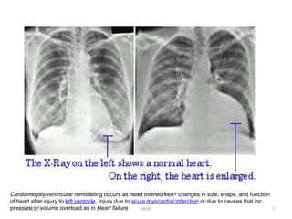 Cardiomegaly/ventricular remodeling occurs as heart overworked> changes in size, shape, and function
of heart after injury to left ventricle. Injury due to acute myocardial infarction or due to causes that inc.
pressure or volume overload as in Heart failure10/16/2019 7PATKI
 