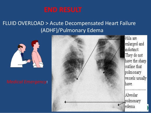 fluid retention congestive heart failure fluid retention congestive heart failure
