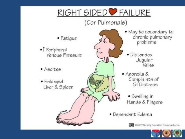 Congestive Cardiac Failure Presentation And Diagnosis
