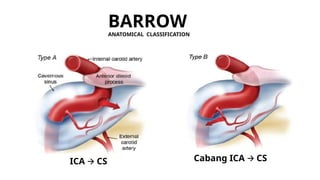 Cavernous Carotid Fistulas & TOLOSA HUNT.pptx