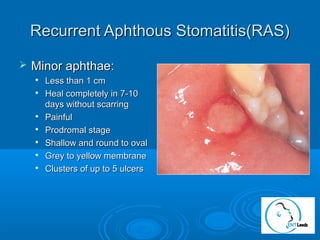 Minor Ras Ulcers How to recognise ENT Cancers (or how to spot the icebergs)? | PPT