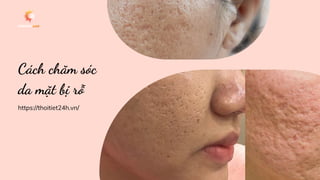 https://thoitiet24h.vn/
Cách chăm sóc
da mặt bị rỗ
 