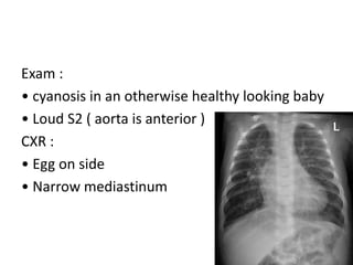 Exam :
• cyanosis in an otherwise healthy looking baby
• Loud S2 ( aorta is anterior )
CXR :
• Egg on side
• Narrow mediastinum
 