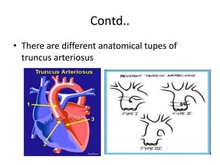 Contd..
• There are different anatomical tupes of
truncus arteriosus
 