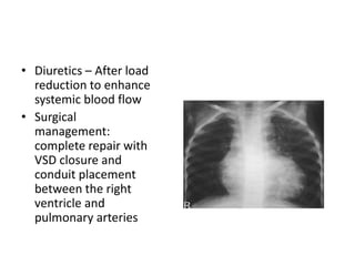 • Diuretics – After load
reduction to enhance
systemic blood flow
• Surgical
management:
complete repair with
VSD closure and
conduit placement
between the right
ventricle and
pulmonary arteries
 