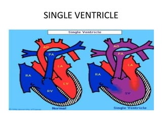 SINGLE VENTRICLE
 