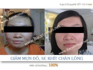 5 bí quyết xác định loại da để trị mụn