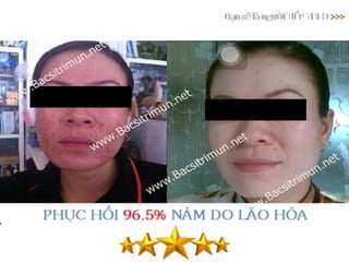 5 bí quyết xác định loại da để trị mụn