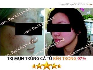 5 bí quyết xác định loại da để trị mụn