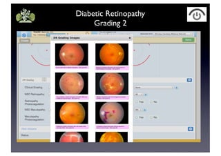 Diabetic Retinopathy
Grading 2