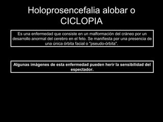Holoprosencefalia alobar o
               CICLOPIA
  Es una enfermedad que consiste en un malformación del cráneo por un
desarrollo anormal del cerebro en el feto. Se manifiesta por una presencia de
                 una única órbita facial o "pseudo-órbita".




Algunas imágenes de esta enfermedad pueden herir la sensibilidad del
                           espectador.
 