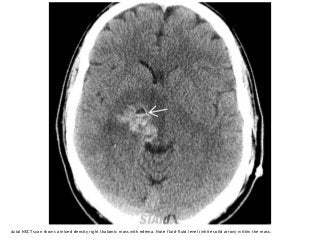 Axial NECT scan shows a mixed density right thalamic mass with edema. Note fluid-fluid level (white solid arrow) within the mass.
 