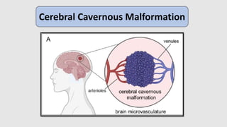 Cerebral Cavernous Malformations
- Disorder known as CCM, mostly affects the neurovasculature.
- Expanded caverns and thic...