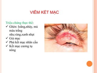 VIÊM KẾT MẠC
Triệu chứng thực thể:
 Ghèn: loãng,nhày, mủ
màu trắng
sữa,vàng,xanh nhạt
 Giả mạc
 Phù kết mạc nhãn cầu
 Kết mạc cương tụ
nông
 