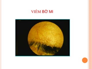 VIÊM BỜ MI
 