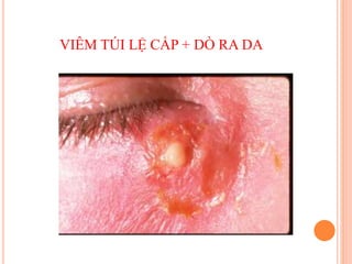 VIÊM TÚI LỆ CẤP + DÒ RA DA
 