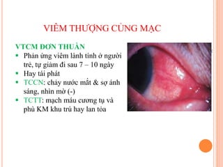 VIÊM THƯỢNG CỦNG MẠC
VTCM ĐƠN THUẦN
 Phản ứng viêm lành tính ở người
trẻ, tự giảm đi sau 7 – 10 ngày
 Hay tái phát
 TCCN: chảy nước mắt & sợ ánh
sáng, nhìn mờ (-)
 TCTT: mạch máu cương tụ và
phù KM khu trú hay lan tỏa
 