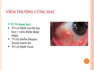 VIÊM THƯỢNG CỦNG MẠC
VTCM dạng hạt:
 5% có bệnh của hệ tạo
keo ( viêm khớp dạng
thấp)
 7% bị nhiễm Herpes
Zoster trước đó
 3% có bệnh Gout
 