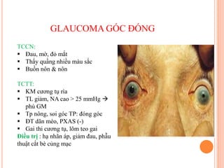 GLAUCOMA GÓC ĐÓNG
TCCN:
 Đau, mờ, đỏ mắt
 Thấy quầng nhiều màu sắc
 Buồn nôn & nôn
TCTT:
 KM cương tụ rìa
 TL giảm, NA cao > 25 mmHg 
phù GM
 Tp nông, soi góc TP: đóng góc
 ĐT dãn méo, PXAS (-)
 Gai thi cương tụ, lõm teo gai
Điều trị : hạ nhãn áp, giảm đau, phẫu
thuật cắt bè củng mạc
 