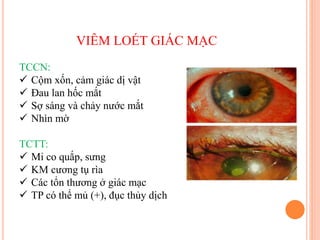 VIÊM LOÉT GIÁC MẠC
TCCN:
 Cộm xốn, cảm giác dị vật
 Đau lan hốc mắt
 Sợ sáng và chảy nước mắt
 Nhìn mờ
TCTT:
 Mi co quắp, sưng
 KM cương tụ rìa
 Các tổn thương ở giác mạc
 TP có thể mủ (+), đục thủy dịch
 