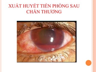 XUẤT HUYẾT TIỀN PHÒNG SAU
CHẤN THƯƠNG
 
