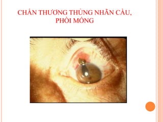 CHẤN THƯƠNG THỦNG NHÃN CẦU,
PHÒI MỐNG
 