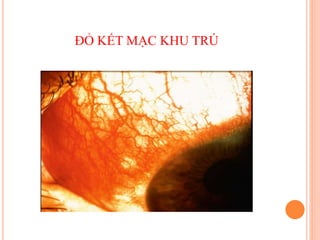ĐỎ KẾT MẠC KHU TRÚ
 