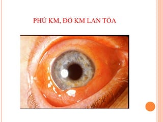 PHÙ KM, ĐỎ KM LAN TỎA
 