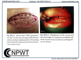 info@npwtindia.com

Contact: +91 9971722111

www.npwtindia.com

AN ISO 13485:2003 CERTIFIED COMPANY

 