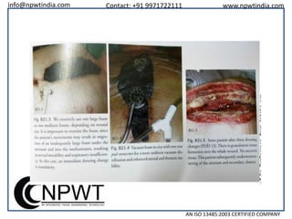 info@npwtindia.com

Contact: +91 9971722111

www.npwtindia.com

AN ISO 13485:2003 CERTIFIED COMPANY

 