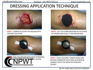 info@npwtindia.com

Contact: +91 9971722111

www.npwtindia.com

DRESSING APPLICATION TECHNIQUE

STEP 1 : DEBRIDE & CLEAN THE WOUND WITH
ISOTONIC SOLUTION

STEP 3: SEAL THE WOUND WITH SEMI-PERMEABLE
DRAPE & MAKE A SMALL HOLE IN THE CENTRE

STEP 2 : CUT THE FOAM DRESSING IN THE SHAPE
OF WOUND AND PLACE IT ON WOUND BED

STEP 4 : STICK THE MAPC TUBING DISTAL END
KEEPING SYMMETRY WITH HOLE IN CENTRE &
CONNECT WITH THE NEGATIVE PRESSURE
SOURCE
AN ISO 13485:2003 CERTIFIED COMPANY

 