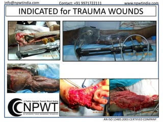 info@npwtindia.com

Contact: +91 9971722111

www.npwtindia.com

INDICATED for TRAUMA WOUNDS

AN ISO 13485:2003 CERTIFIED COMPANY

 