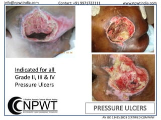 info@npwtindia.com

Contact: +91 9971722111

www.npwtindia.com

Indicated for all
Grade II, III & IV
Pressure Ulcers

AN ISO 13485:2003 CERTIFIED COMPANY

 