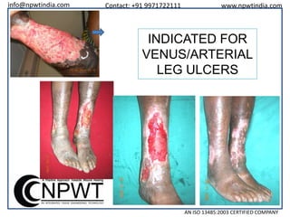 info@npwtindia.com

Contact: +91 9971722111

www.npwtindia.com

INDICATED FOR
VENUS/ARTERIAL
LEG ULCERS

AN ISO 13485:2003 CERTIFIED COMPANY

 