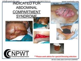 info@npwtindia.com

Contact: +91 9971722111

INDICATED FOR
ABDOMINAL
COMPARTMENT
SYNDROME

www.npwtindia.com

Infected Laprotomy

**Please seek advice for special Dressing selection
AN ISO 13485:2003 CERTIFIED COMPANY

 