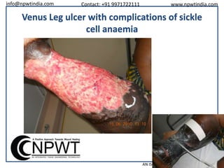 info@npwtindia.com

Contact: +91 9971722111

www.npwtindia.com

Venus Leg ulcer with complications of sickle
cell anaemia

AN ISO 13485:2003 CERTIFIED COMPANY

 