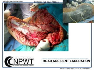 info@npwtindia.com

Contact: +91 9971722111

www.npwtindia.com

ROAD ACCIDENT LACERATION
AN ISO 13485:2003 CERTIFIED COMPANY

 