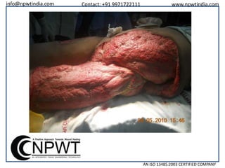 info@npwtindia.com

Contact: +91 9971722111

www.npwtindia.com

AN ISO 13485:2003 CERTIFIED COMPANY

 