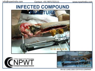 info@npwtindia.com

Contact: +91 9971722111

www.npwtindia.com

INFECTED COMPOUND
FRACTURE

AN ISO 13485:2003 CERTIFIED COMPANY

 
