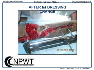 info@npwtindia.com

Contact: +91 9971722111

www.npwtindia.com

AFTER Ist DRESSING
CHANGE

AN ISO 13485:2003 CERTIFIED COMPANY

 