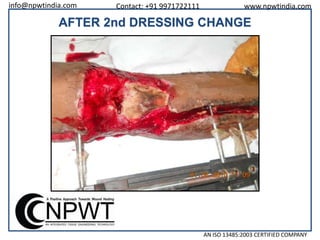 info@npwtindia.com

Contact: +91 9971722111

www.npwtindia.com

AFTER 2nd DRESSING CHANGE

AN ISO 13485:2003 CERTIFIED COMPANY

 