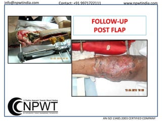 info@npwtindia.com

Contact: +91 9971722111

www.npwtindia.com

FOLLOW-UP
POST FLAP

AN ISO 13485:2003 CERTIFIED COMPANY

 