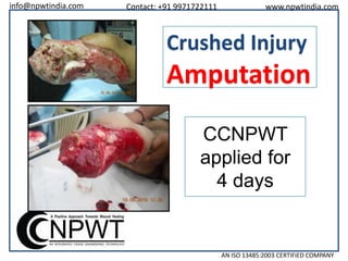 info@npwtindia.com

Contact: +91 9971722111

www.npwtindia.com

Crushed Injury

Amputation
CCNPWT
applied for
4 days

AN ISO 13485:2003 CERTIFIED COMPANY

 