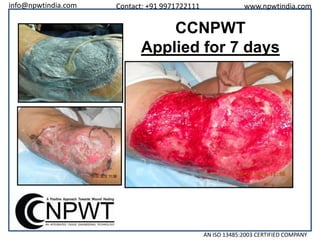 info@npwtindia.com

Contact: +91 9971722111

www.npwtindia.com

CCNPWT
Applied for 7 days

AN ISO 13485:2003 CERTIFIED COMPANY

 