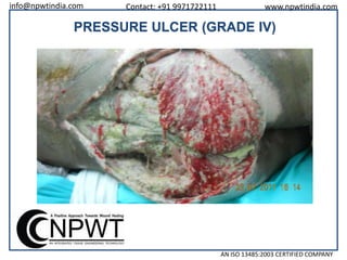 info@npwtindia.com

Contact: +91 9971722111

www.npwtindia.com

PRESSURE ULCER (GRADE IV)

AN ISO 13485:2003 CERTIFIED COMPANY

 