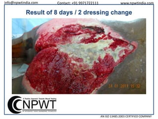 info@npwtindia.com

Contact: +91 9971722111

www.npwtindia.com

Result of 8 days / 2 dressing change

AN ISO 13485:2003 CERTIFIED COMPANY

 