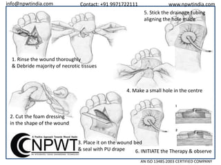 info@npwtindia.com

Contact: +91 9971722111

www.npwtindia.com
5. Stick the drainage tubing
aligning the hole made

1. Rinse the wound thoroughly
& Debride majority of necrotic tissues

4. Make a small hole in the centre

2. Cut the foam dressing
in the shape of the wound

3. Place it on the wound bed
& seal with PU drape
6. INITIATE the Therapy & observe
AN ISO 13485:2003 CERTIFIED COMPANY

 
