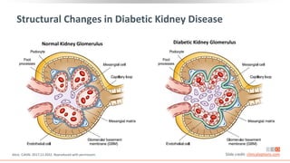 Structural Changes in Diabetic Kidney Disease
Alicic. CJASN. 2017;12:2032. Reproduced with permission.
Normal Kidney Glomerulus Diabetic Kidney Glomerulus
Slide credit: clinicaloptions.com
 